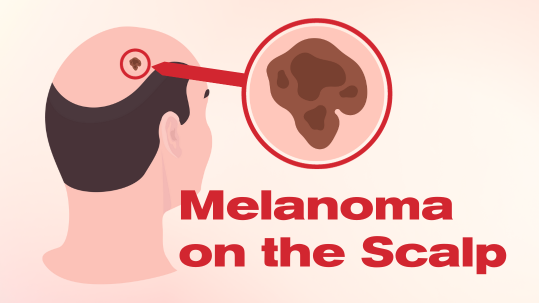 melanoma on the scalp